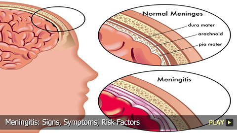 Meningitis: Signs, Symptoms, Risk Factors