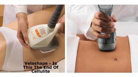 Goodbye Cellulite With Velashape