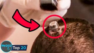 Top 20 Facts About Brain Implants