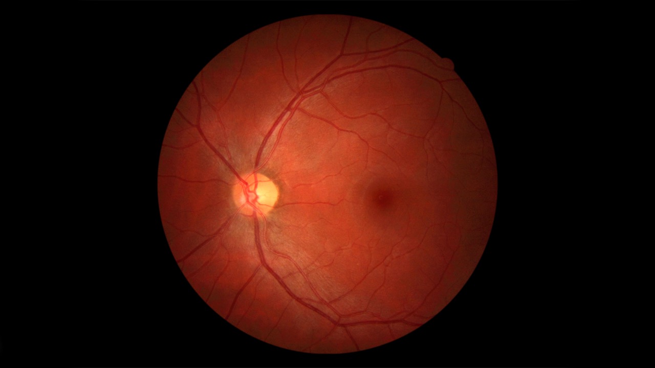 Diabetes Eye Exam: Test Against Early Blindness